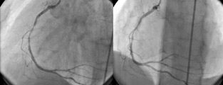 Comparación entre angiotc coronario y angiografía convencional en patologia ateroesclerótica coronaria