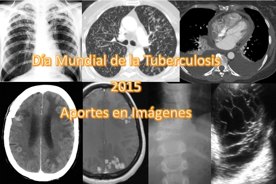 Día Mundial de la Tuberculosis, 2015. Aportes en Imágenes
